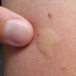 Mosquito Bite Remedies