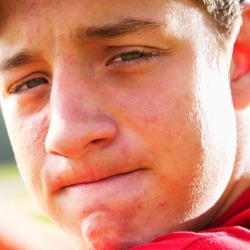 Acne Scars
