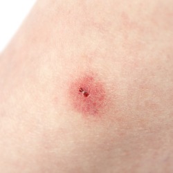 Human flesh with large read insect bite