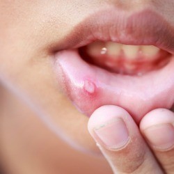 Child holding lip down to show blister on inner lip