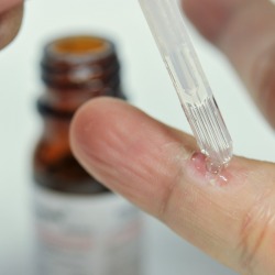 Treating a wart at home.