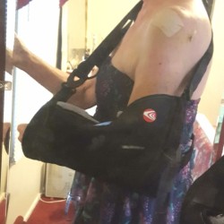 A woman wearing a sleeveless sun dress with her arm in a sling.