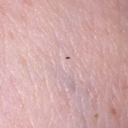 Getting Rid of Small Black Biting Bugs - bug on skin