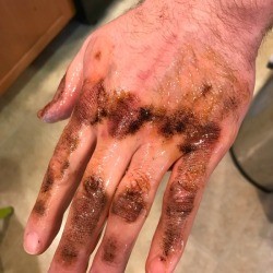 A hand covered in sticky roof tar from construction.