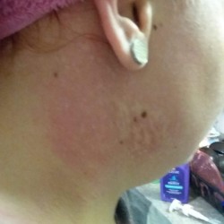Dyeing Your Hair After Bleaching - pink rash on neck