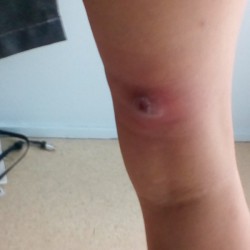 Treating Boils - boil on back of leg above the knee