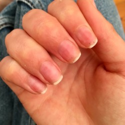 Throbbing Pain after GEL Nail Removal - right hand