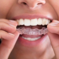 A woman placing a retainer in her mouth.